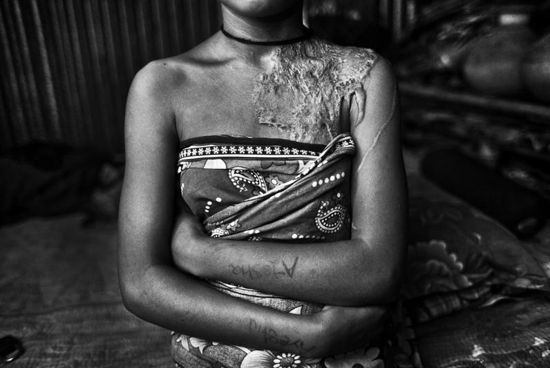 Hai nguoi bi tat axit bong nang vi ghen tuong mu quang hinh anh