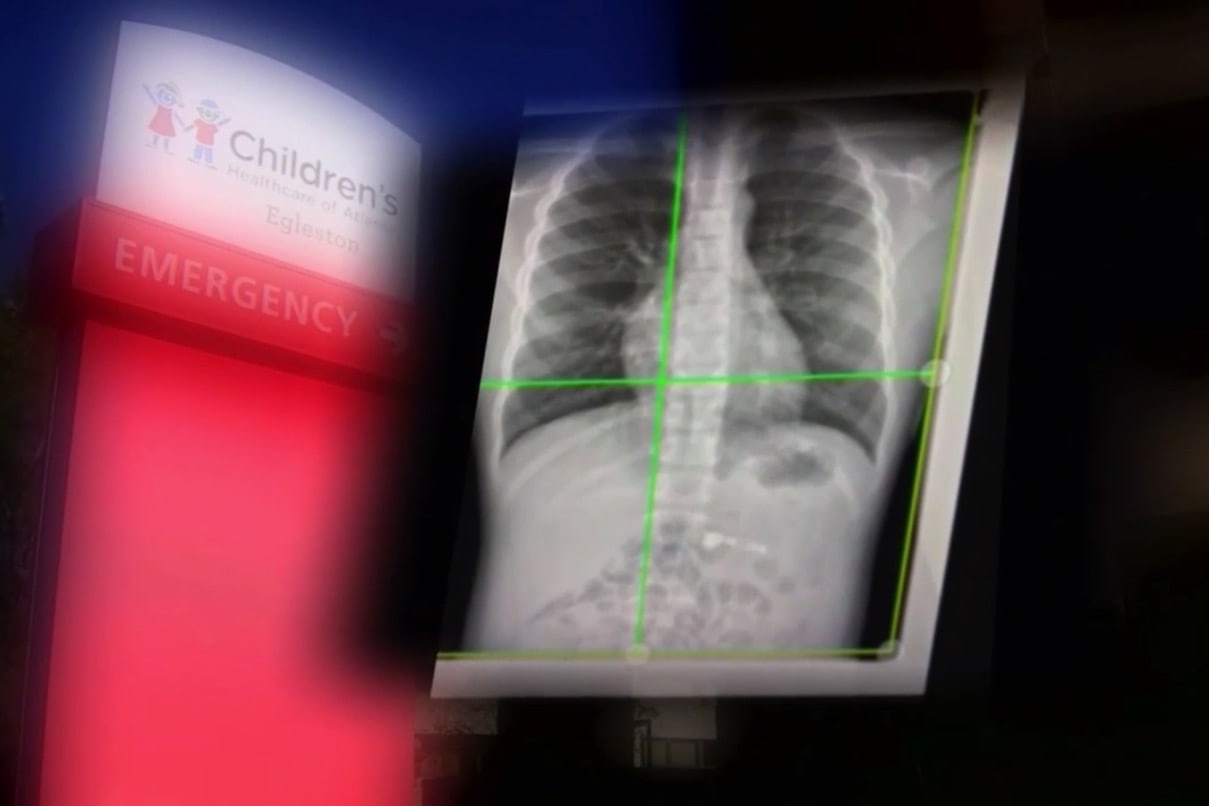 Cau be 7 tuoi nhap vien vi nuot phai AirPods hinh anh