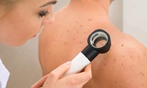 Meo phong tranh viem nang long hinh anh