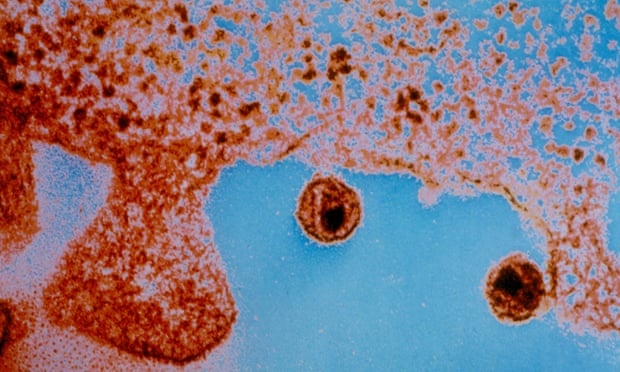 Nu benh nhan HIV dau tien duoc chua khoi hinh anh