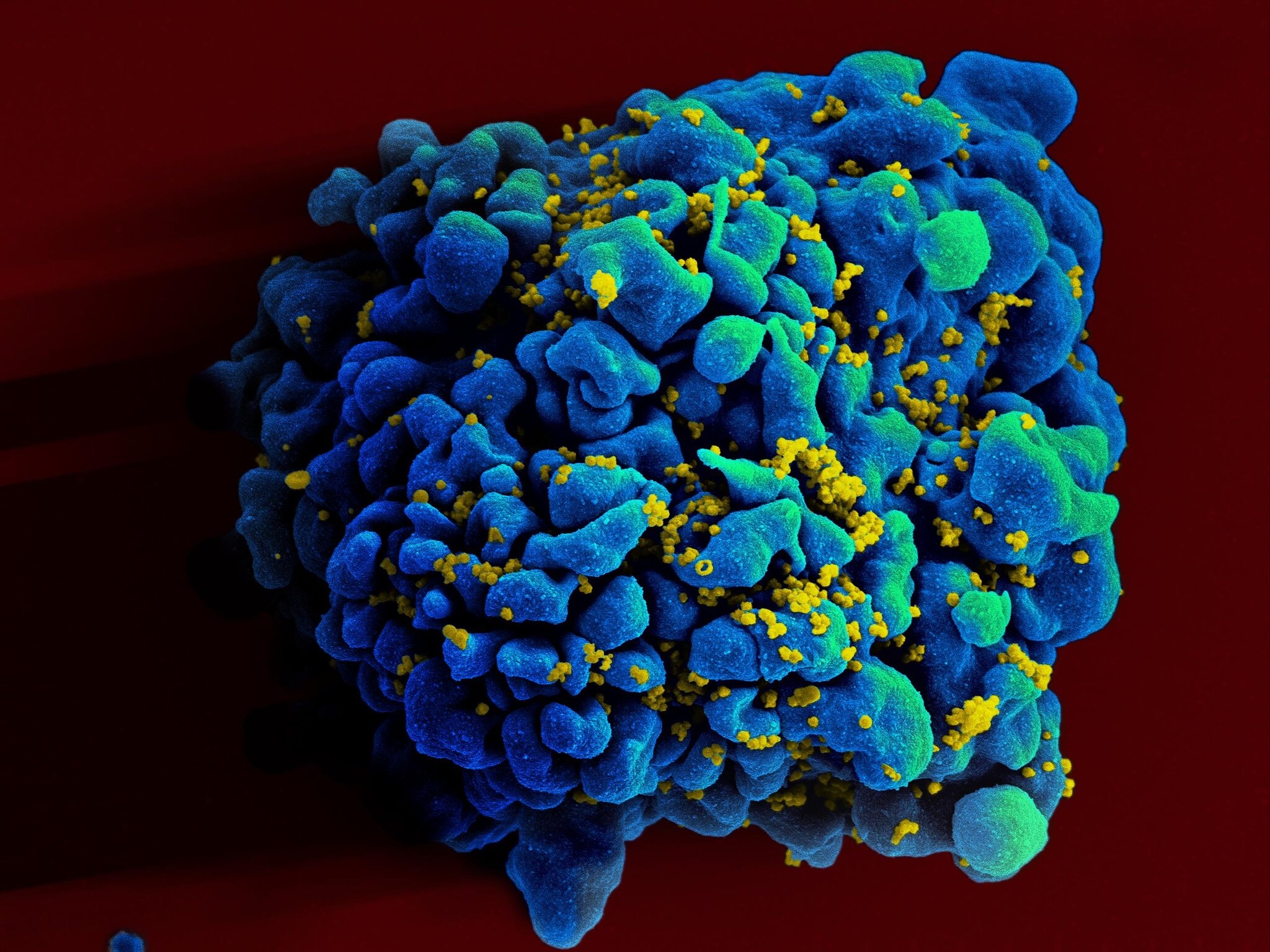 chữa khỏi HIV ảnh 1 chua khoi HIV anh 1