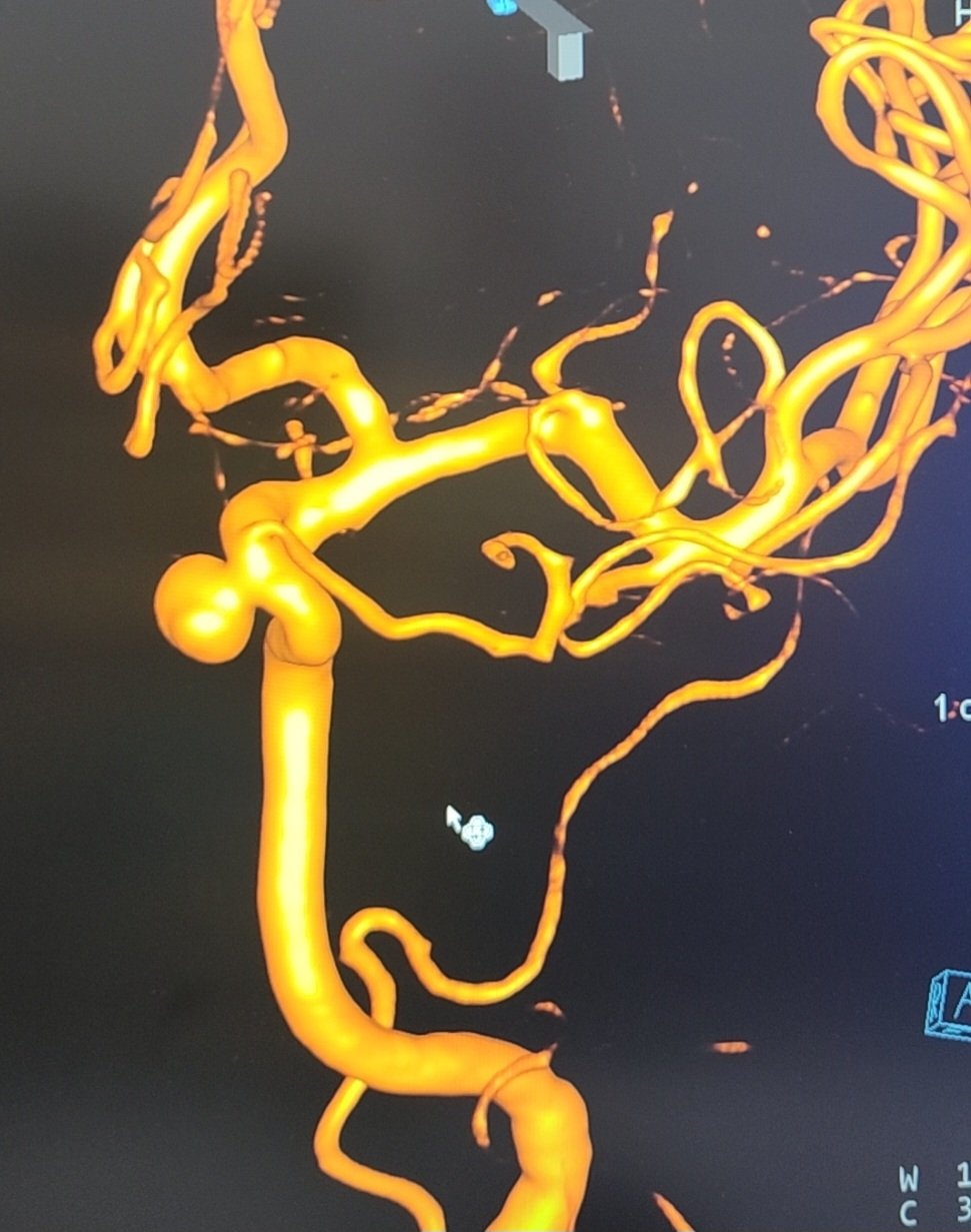 BV Tâm Anh, mạch máu não ảnh 1 BV Tam Anh, mach mau nao anh 1