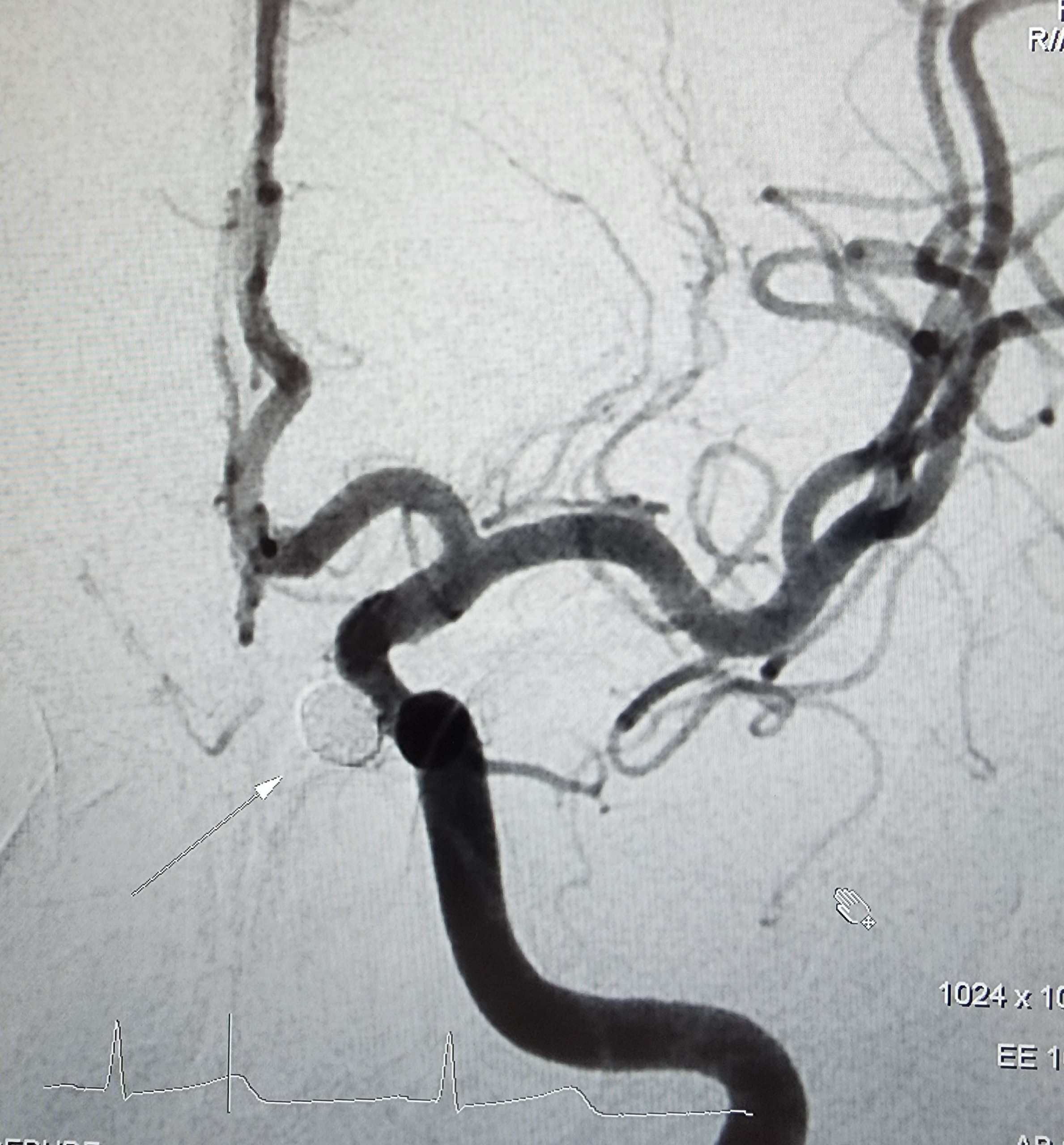 BV Tâm Anh, mạch máu não ảnh 2 BV Tam Anh, mach mau nao anh 2