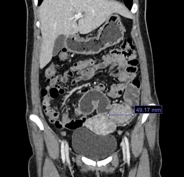 BVDK Tam Anh,  polyp dai trang anh 1