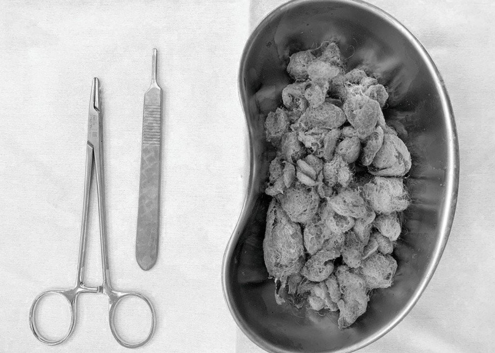 BVDK Tam Anh,  nuot bong gon anh 3