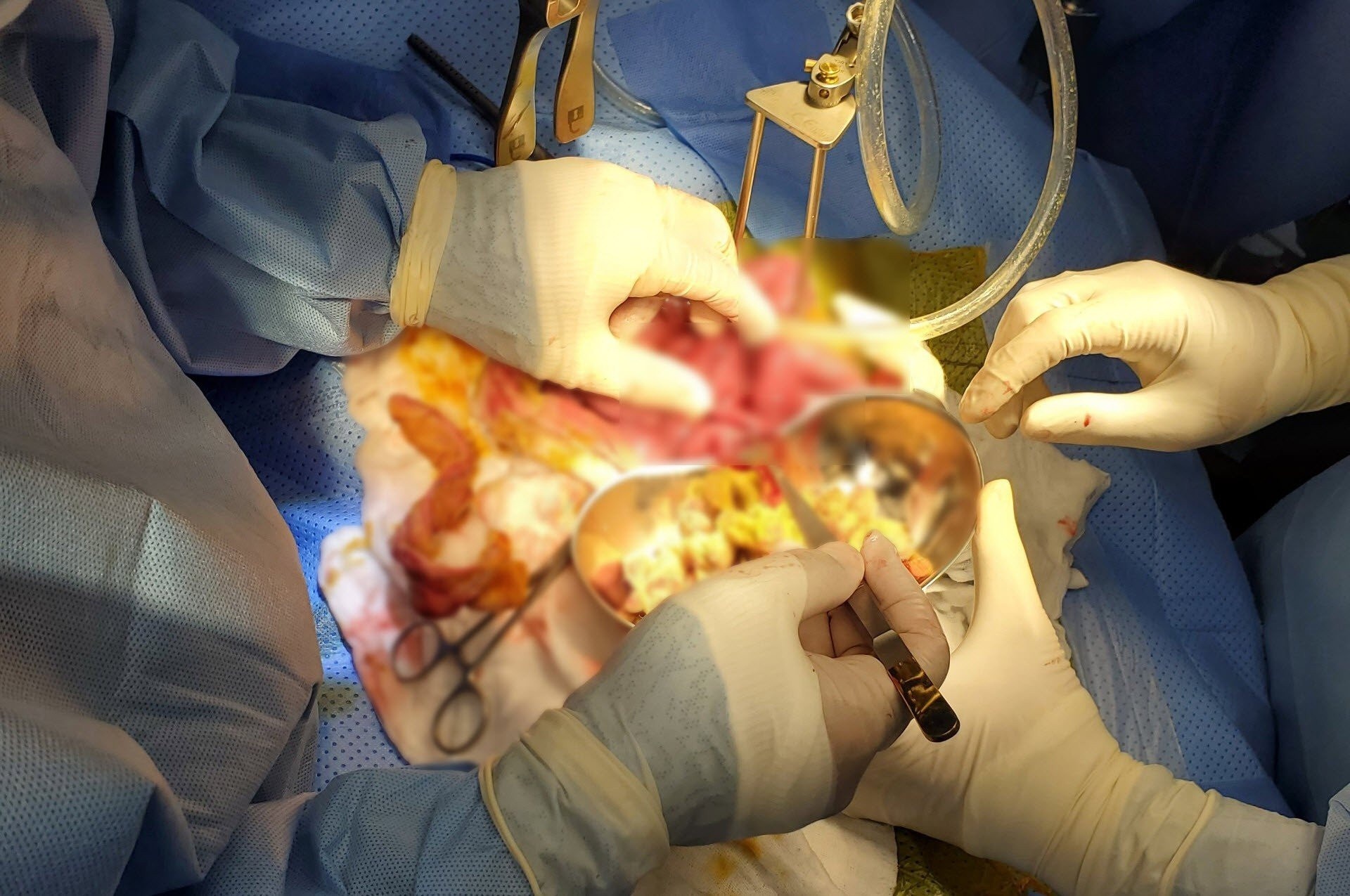 BVDK Tam Anh,  nuot bong gon anh 1