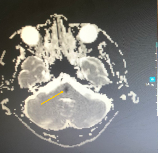 BVĐK Tâm Anh, đột quỵ ảnh 2 BVDK Tam Anh, dot quy anh 2