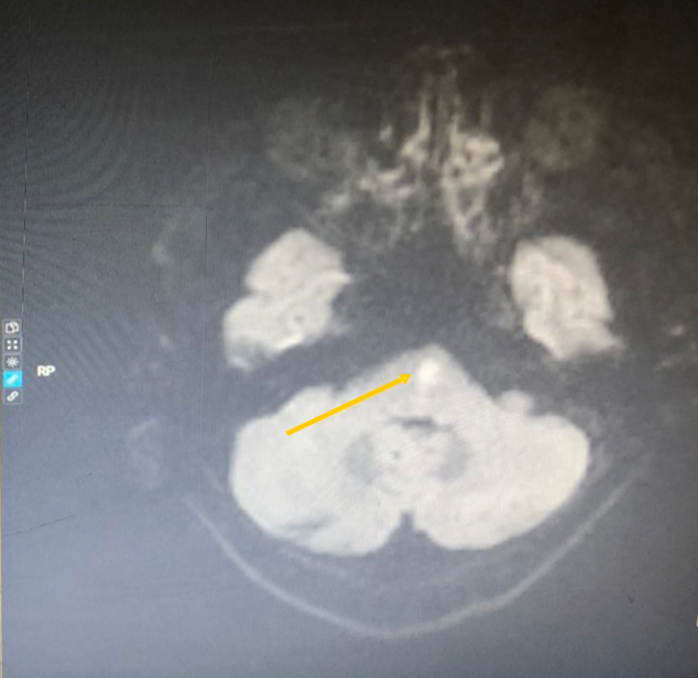 BVĐK Tâm Anh, đột quỵ ảnh 3 BVDK Tam Anh, dot quy anh 3