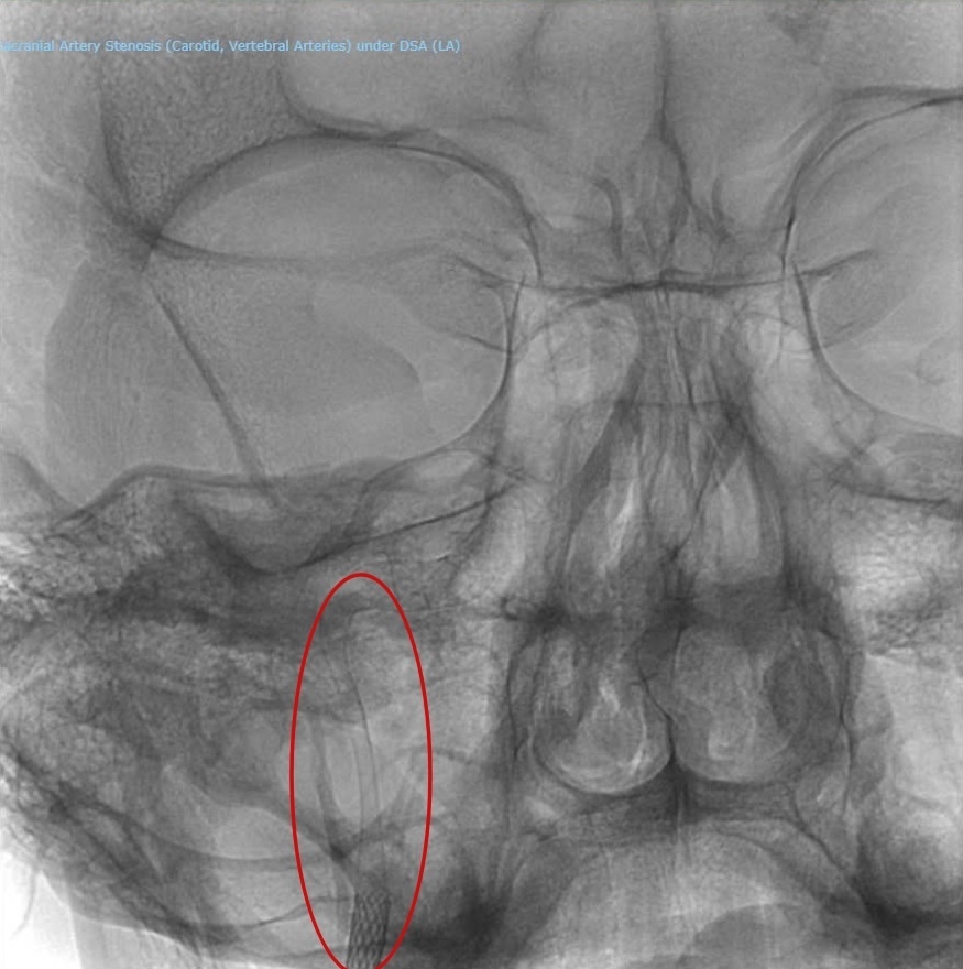 Benh vien FV,  tach dong mach canh anh 3