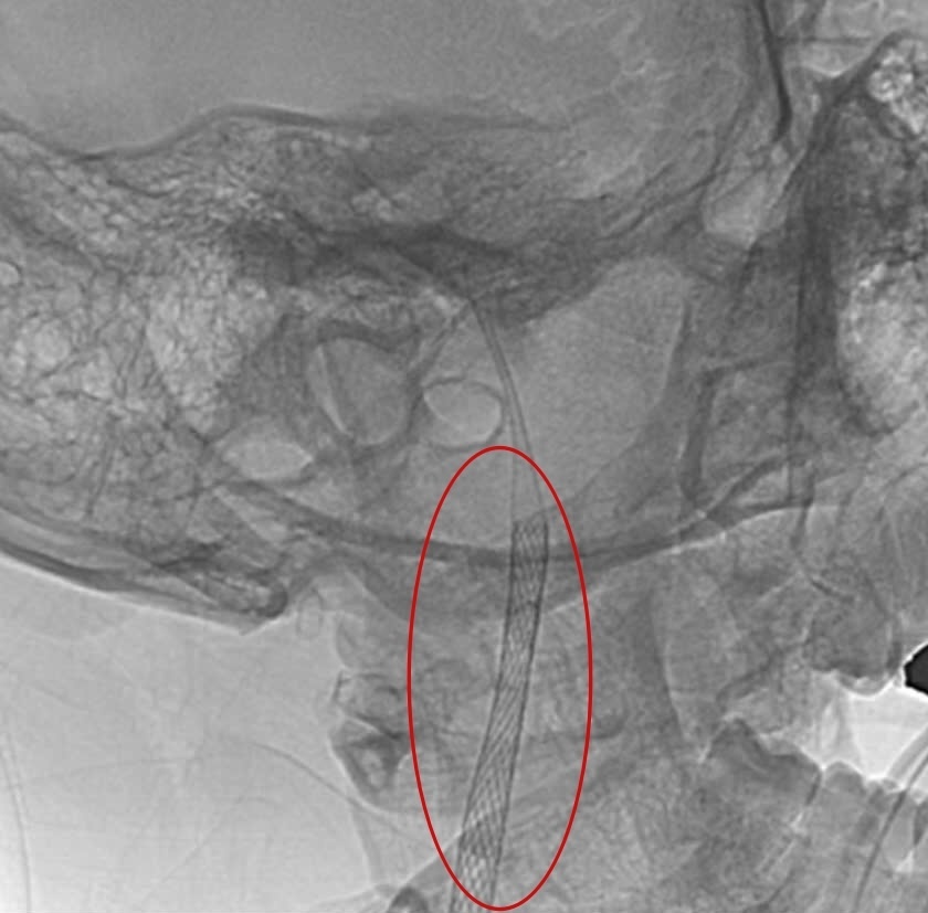 Benh vien FV,  tach dong mach canh anh 4