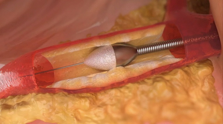 Benh vien FV,  cong nghe Rotapro anh 2