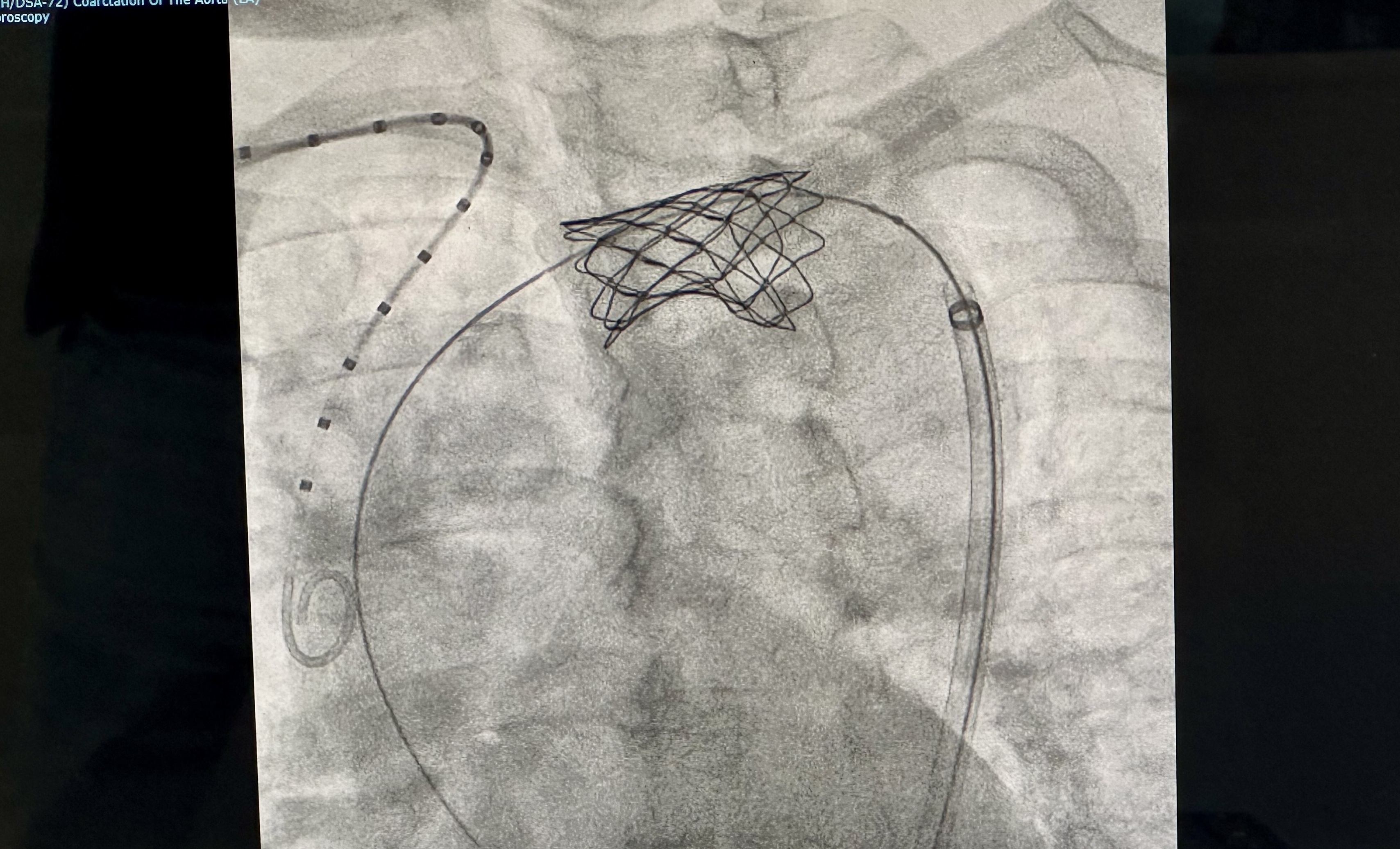 Benh vien FV,  hep eo dong mach anh 4