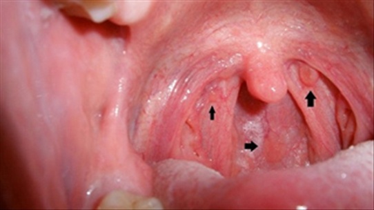 Ung thu khoang mieng anh 1