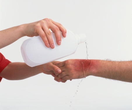 Xử lý vết bỏng đúng cách ảnh 1 Xu ly vet bong dung cach anh 1