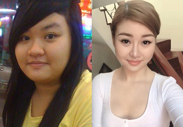 lot xac sau khi phau thuat tham my giam can anh 1