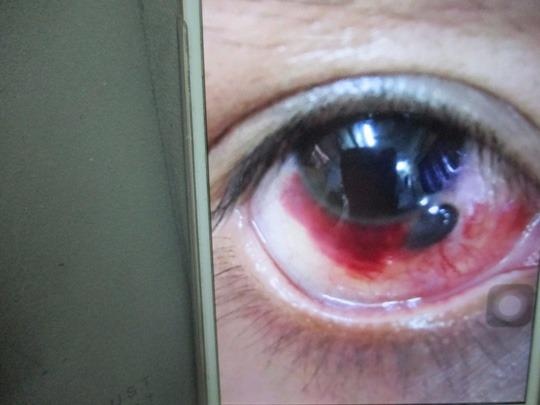 Bi thung mong mat vi cung ly bia qua manh hinh anh