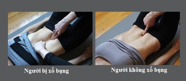 Xổ bụng sau sinh ảnh 2 Xo bung sau sinh anh 2