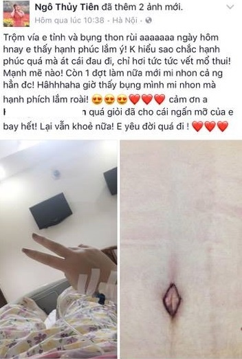Thủy Tiên hút mỡ bụng ảnh 1 Thuy Tien hut mo bung anh 1