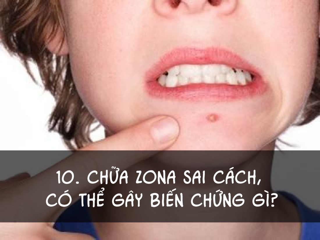 Cách điều trị bệnh zona ảnh 10 Cach dieu tri benh zona anh 10
