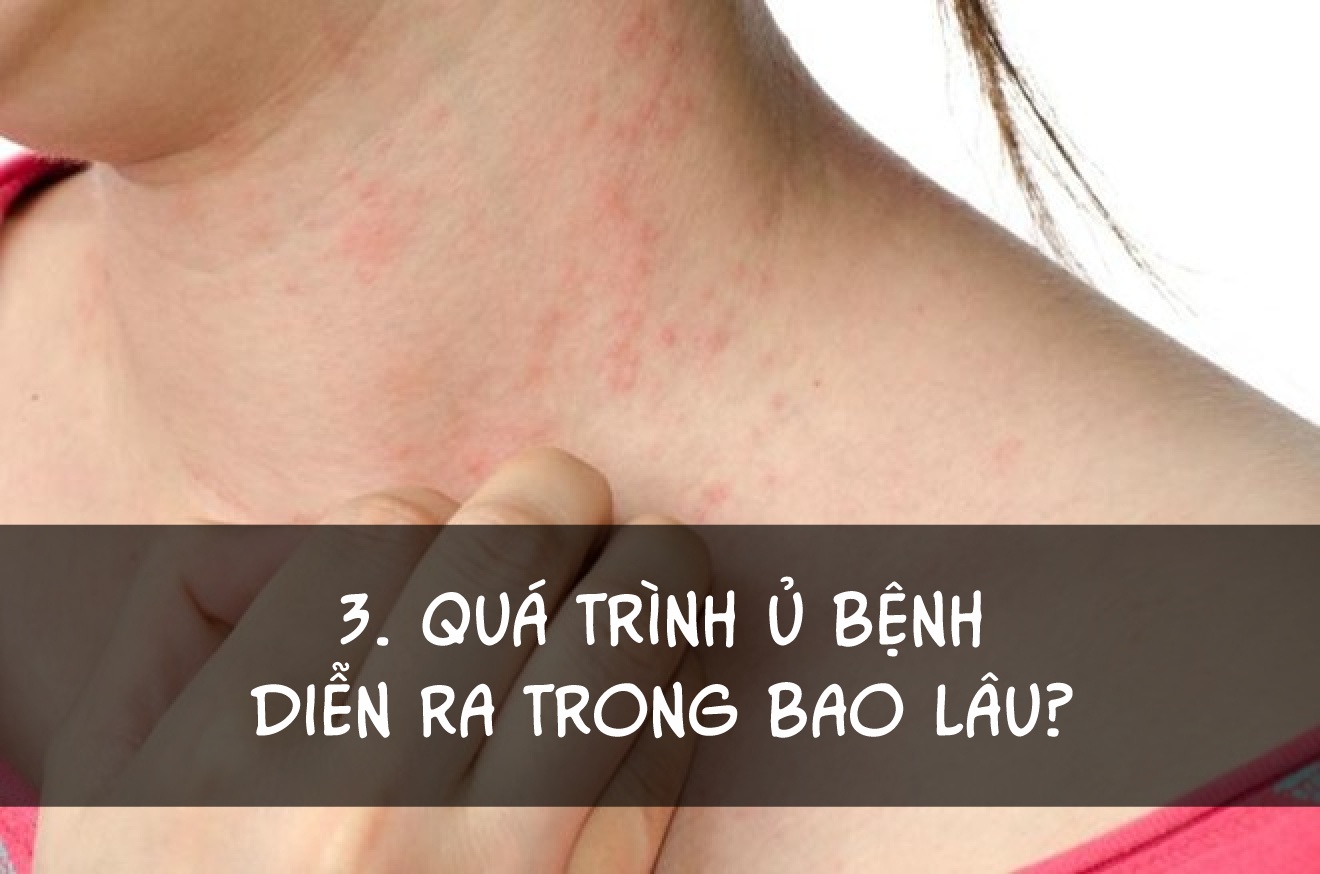 Cách điều trị bệnh zona ảnh 3 Cach dieu tri benh zona anh 3