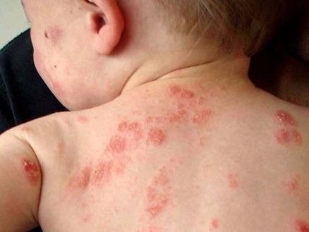 Sai lam khi chua benh zona (gioi leo) hinh anh