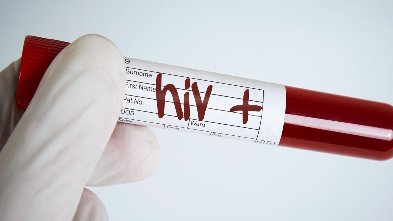 Lam gi khi bi phoi nhiem HIV? hinh anh