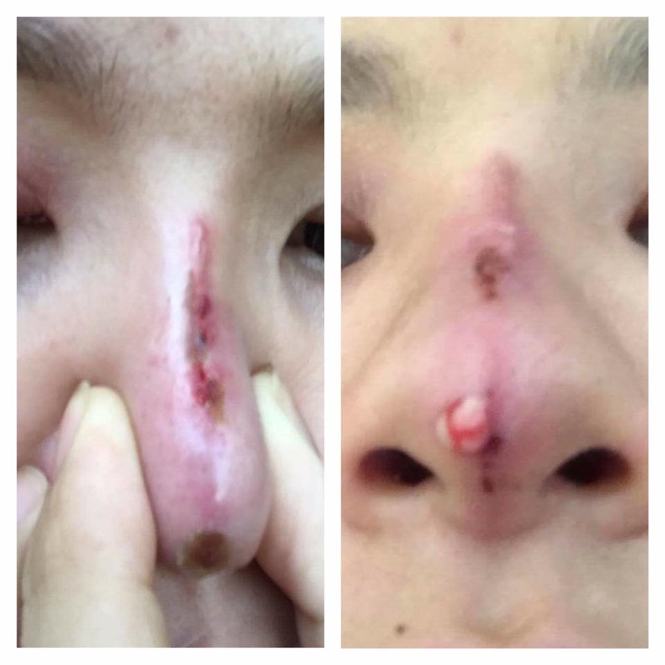 Nâng mũi chỉ ảnh 2 Nang mui chi anh 2