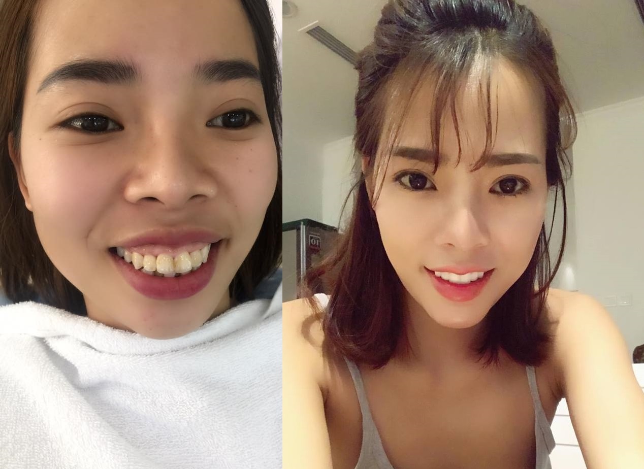 Cô gái thay đổi sau phẫu thuật thẩm mỹ ảnh 1 Co gai thay doi sau phau thuat tham my anh 1