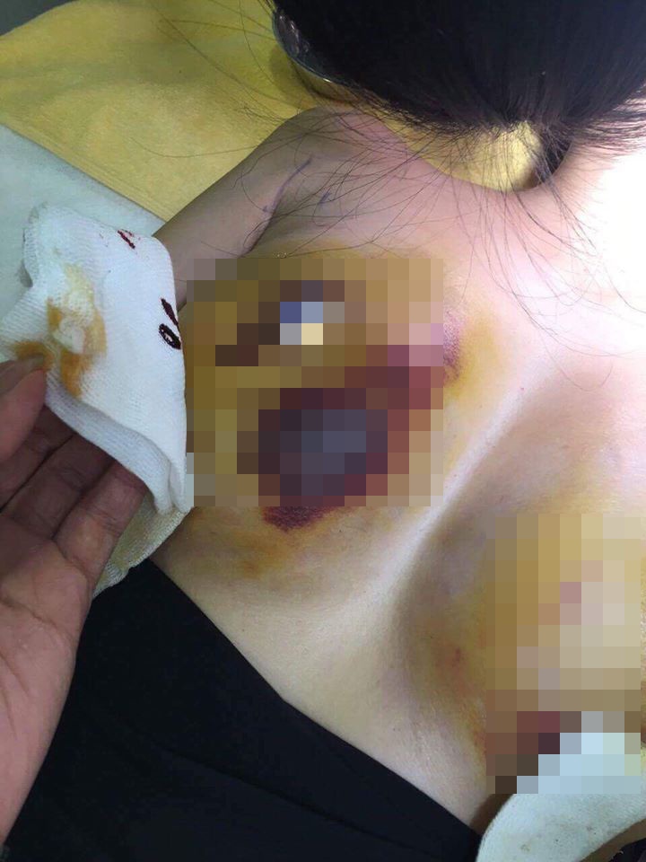 Phẫu thuật nâng ngực hỏng ảnh 1 Phau thuat nang nguc hong anh 1