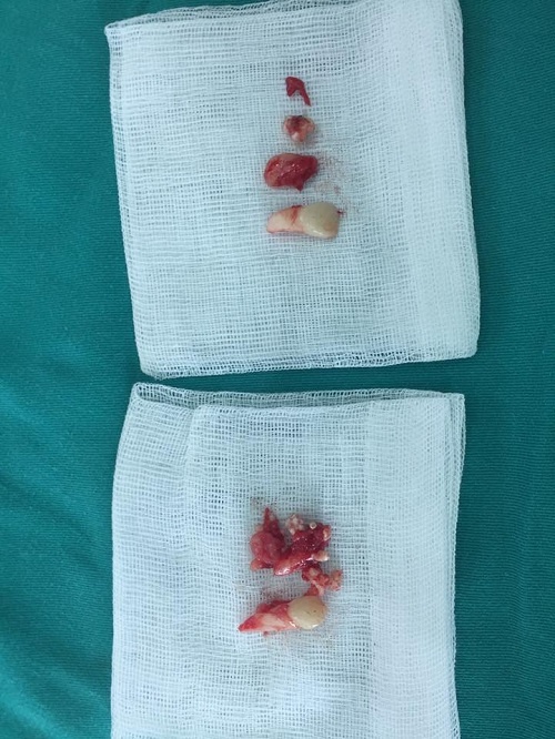 14 tuoi van con rang sua phat hien u rang anh 2