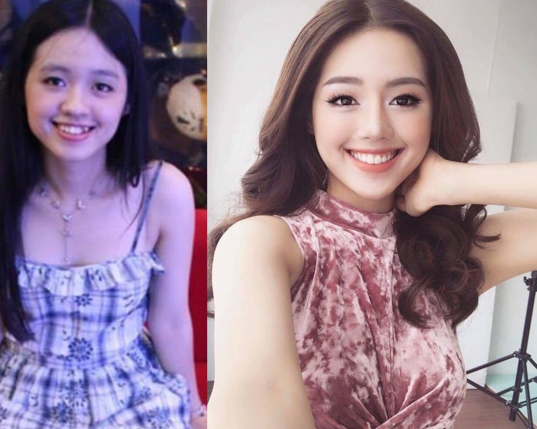 Khánh Linh The Face niềng răng ảnh 1 Khanh Linh The Face nieng rang anh 1