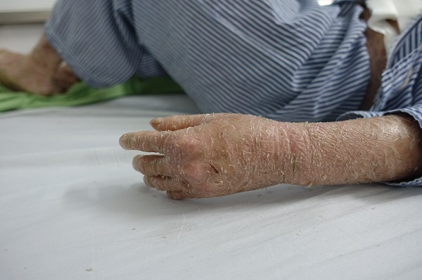 Co gai 29 nam chien dau voi can benh lot da nhu ran hinh anh