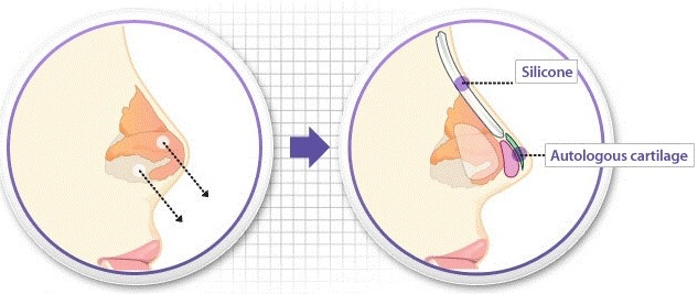Viem xoang co duoc nang mui anh 1