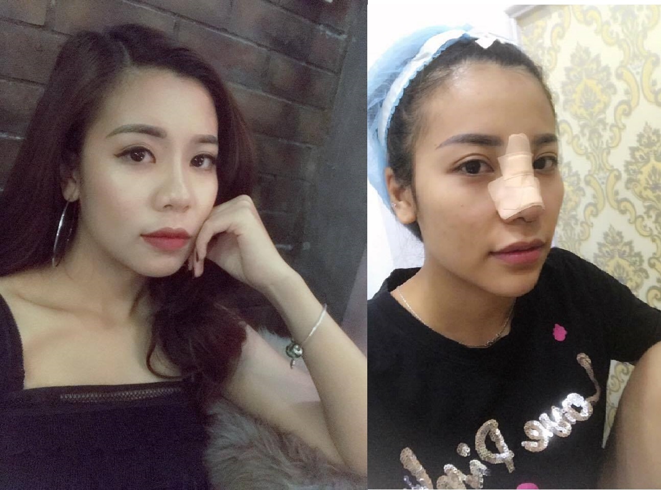 Nâng mũi bằng chỉ ảnh 1 Nang mui bang chi anh 1