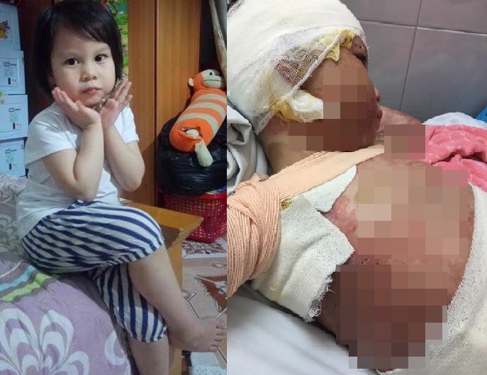 bé gái 5 tuổi bỏng toàn thân ảnh 1 be gai 5 tuoi bong toan than anh 1