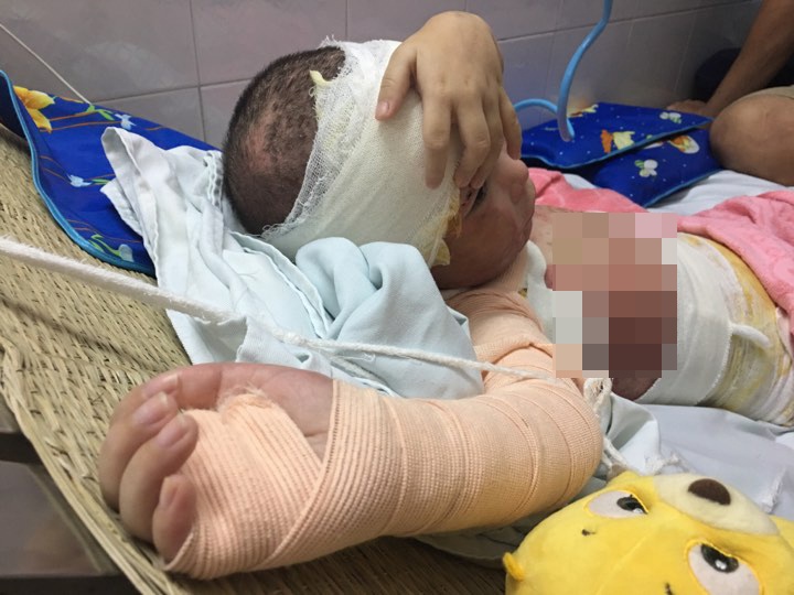 bé gái 5 tuổi bỏng toàn thân ảnh 2 be gai 5 tuoi bong toan than anh 2