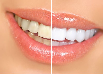 Tẩy trắng răng ảnh 1 Tay trang rang anh 1