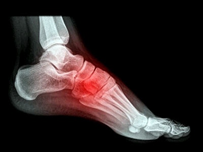 bệnh gout ảnh 3 benh gout anh 3