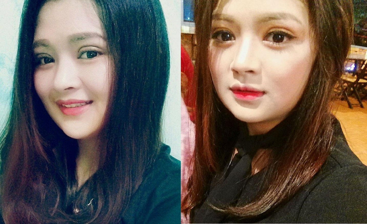 9X phẫu thuật thẩm mỹ ảnh 2 9X phau thuat tham my anh 2