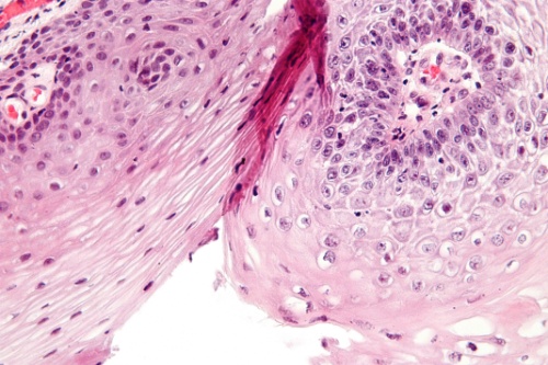 Bệnh sùi mào gà ảnh 3 Benh sui mao ga anh 3