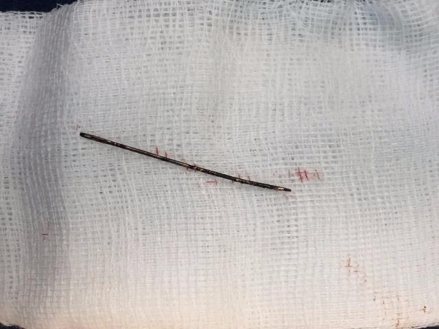 Phau thuat lay kim khau da gi set trong long nguc be gai 3 tuoi hinh anh