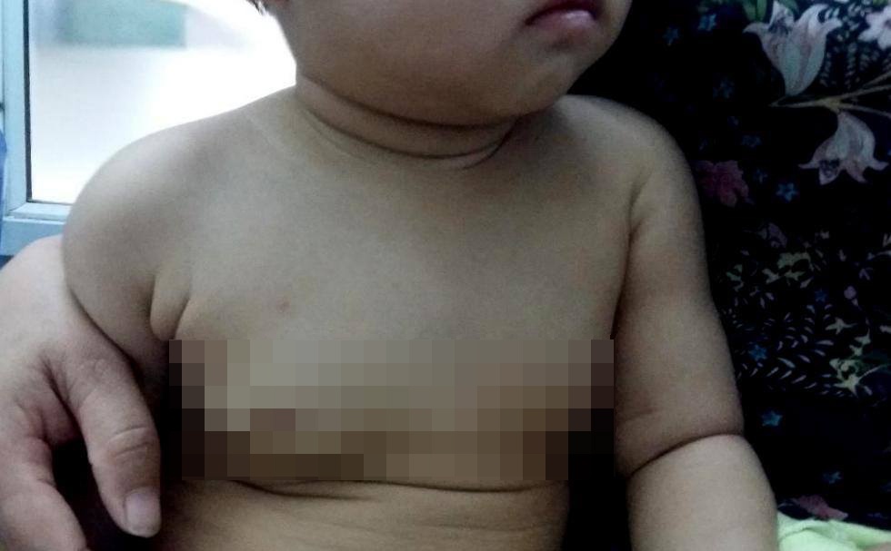 Bé gái 16 tháng tuổi phì đại tuyến vú ảnh 1 Be gai 16 thang tuoi phi dai tuyen vu anh 1
