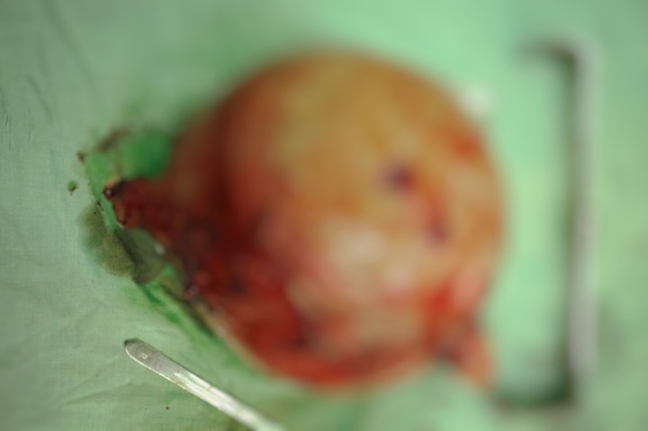 Cat bo khoi u nang 6 kg anh 2