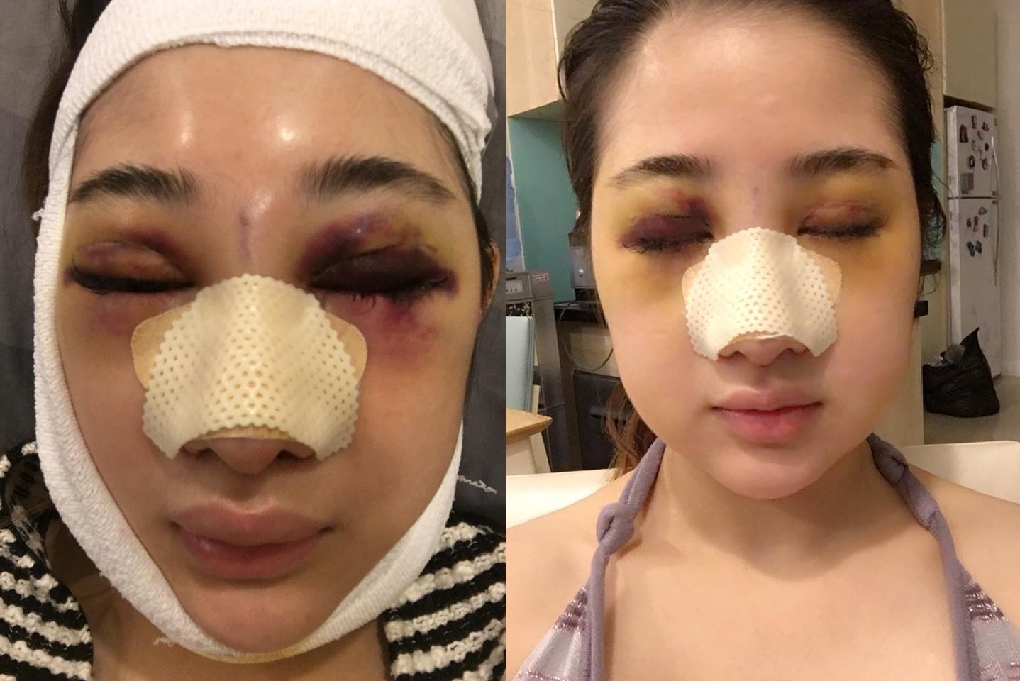 cô gái phẫu thuật toàn bộ gương mặt ảnh 2 co gai phau thuat toan bo guong mat anh 2