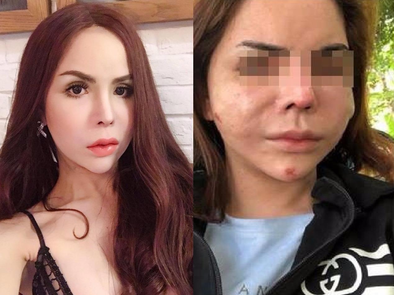 Co gai chuyen gioi mat bien dang sau khi nao silicone hinh anh