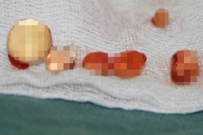 Biến dạng vì tiêm silicone lỏng ảnh 3 Bien dang vi tiem silicone long anh 3