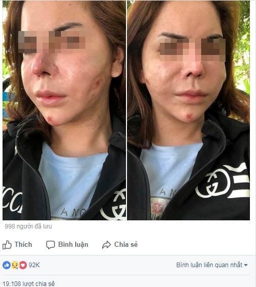 Biến dạng vì tiêm silicone lỏng ảnh 4 Bien dang vi tiem silicone long anh 4