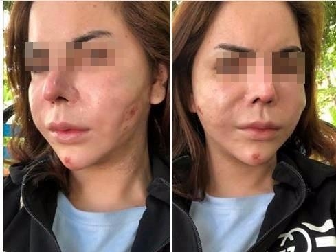 Nguoi hong mat, ke suyt mat nguc vi tiem silicone long hinh anh