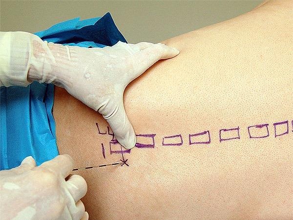 Co nen gay te ngoai mang cung khi sinh? hinh anh