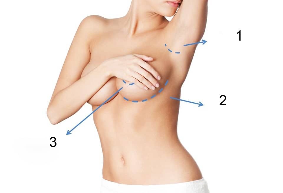 Chọn đường mổ khi nâng ngực ảnh 1 Chon duong mo khi nang nguc anh 1